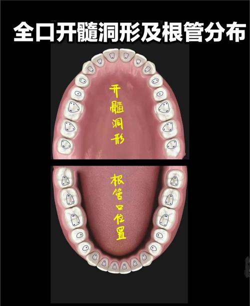 八种揭开髓室顶的方法-图1