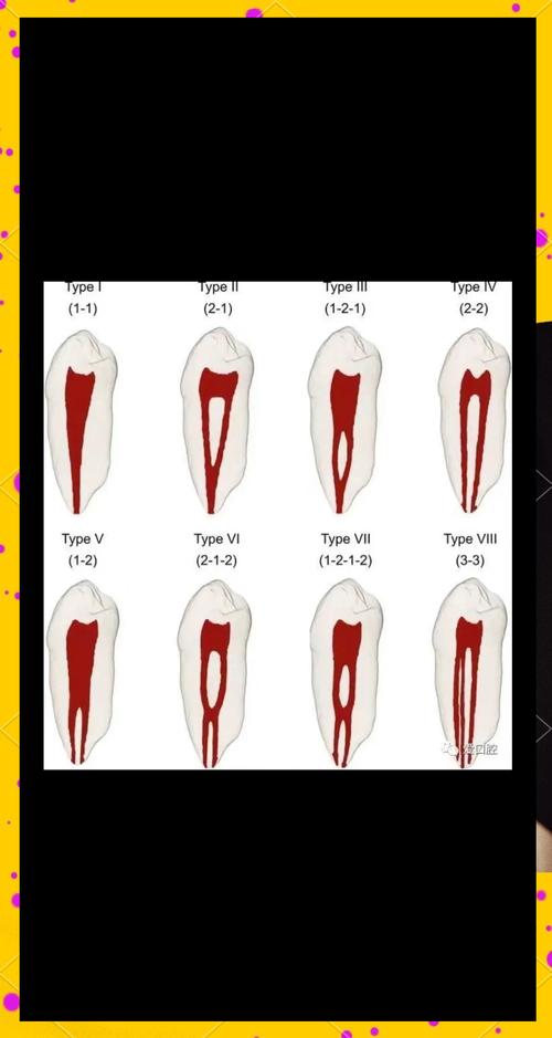 八种揭开髓室顶的方法-图2