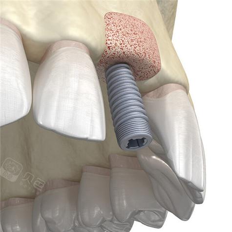 种牙骨究竟是什么样子的?种植牙手术中骨头的真实形态与结构解析-图1 种牙骨究竟是什么样子的?种植牙手术中骨头的真实形态与结构解析-图1