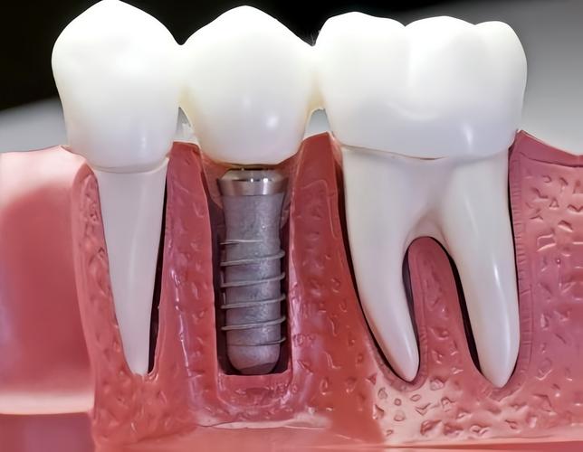 种牙骨究竟是什么样子的？种植牙手术中骨头的真实形态与结构解析-图2