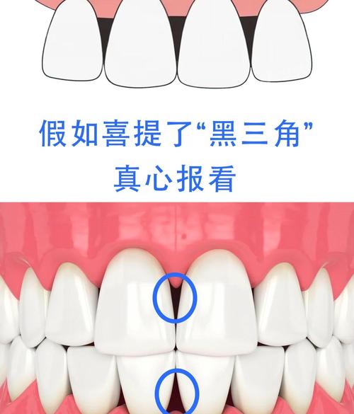 牙齿正畸黑三角的原因-图1