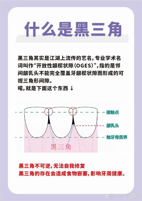 牙齿正畸黑三角的原因-图2