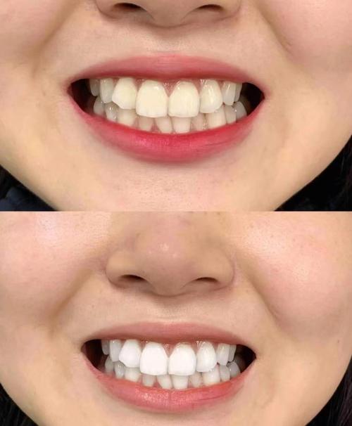 什么方法能让牙齿变白-图3