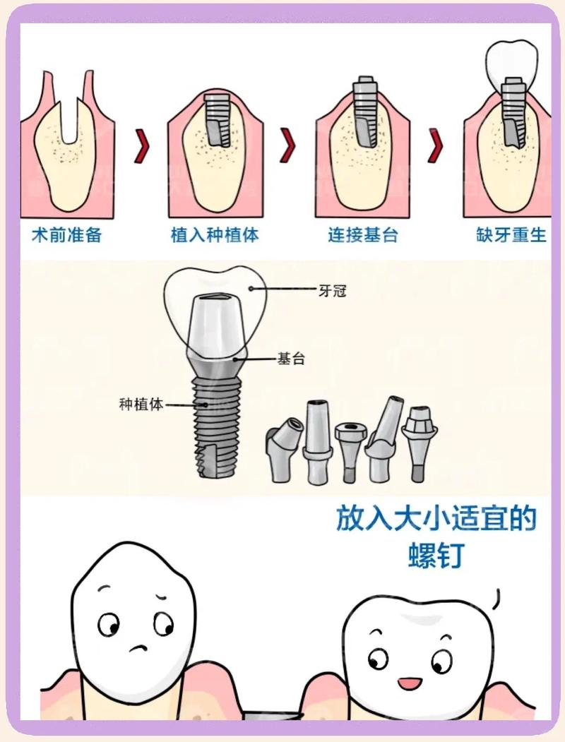 植牙技术到底是什么?原理与效果如何?-图1 植牙技术到底是什么?原理与效果如何?-图1