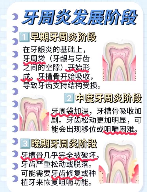 牙周炎的治疗方法有哪些？如何选择适合自己的治疗方式？-图2