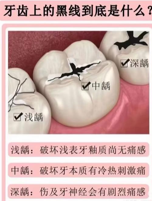 有龋齿的人能种牙吗？是否需先治疗龋齿再进行种植牙？-图1