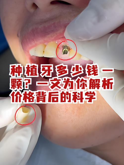 种牙前必须去残根吗？这步不做会影响种植效果吗？-图3