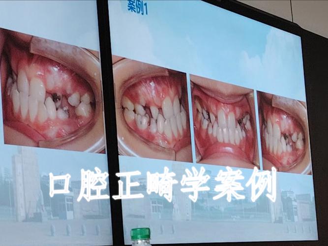 中华口腔医学会正畸学标准如何指导临床实践?-图2 中华口腔医学会正畸学标准如何指导临床实践?-图2