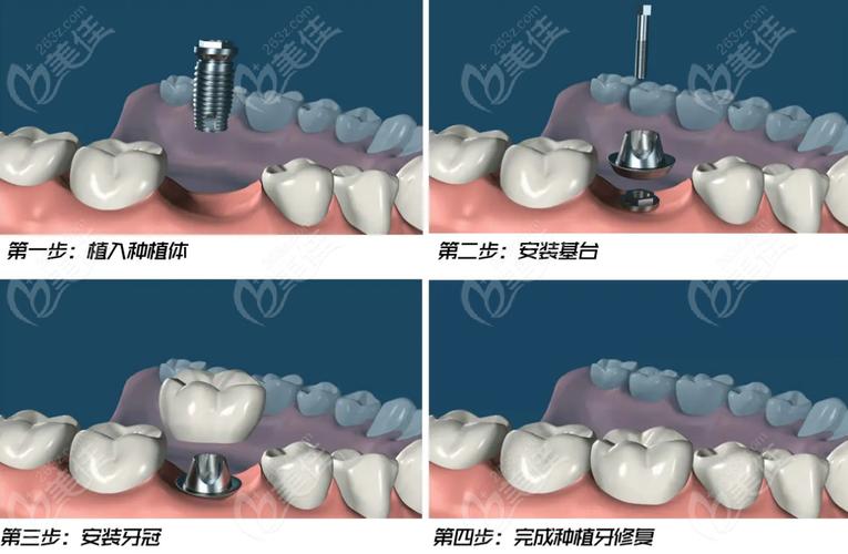 种半口种植牙的具体步骤有哪些?从术前到术后需经历哪些环节?-图1 种半口种植牙的具体步骤有哪些?从术前到术后需经历哪些环节?-图1