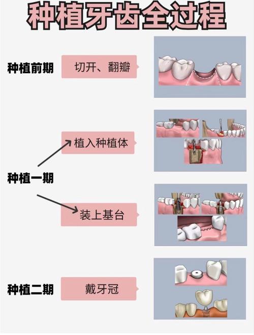 如何判断自己是否适合种植牙？-图3