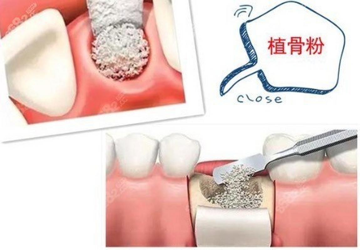 种牙对骨头伤害大吗?术后恢复与长期健康有影响吗?-图2 种牙对骨头伤害大吗?术后恢复与长期健康有影响吗?-图2