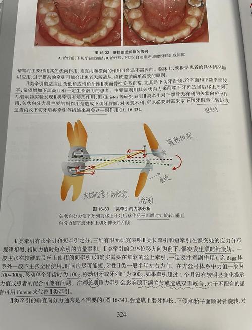 正畸中二类牵引的作用机制及临床应用效果是什么?-图1 正畸中二类牵引的作用机制及临床应用效果是什么?-图1