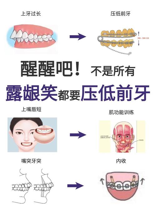 种植牙手术中笑气能用吗?安全性与适用情况解析?-图2 种植牙手术中笑气能用吗?安全性与适用情况解析?-图2