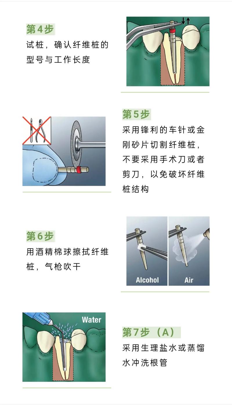 3M纤维桩粘接方法如何规范操作确保效果？-图1