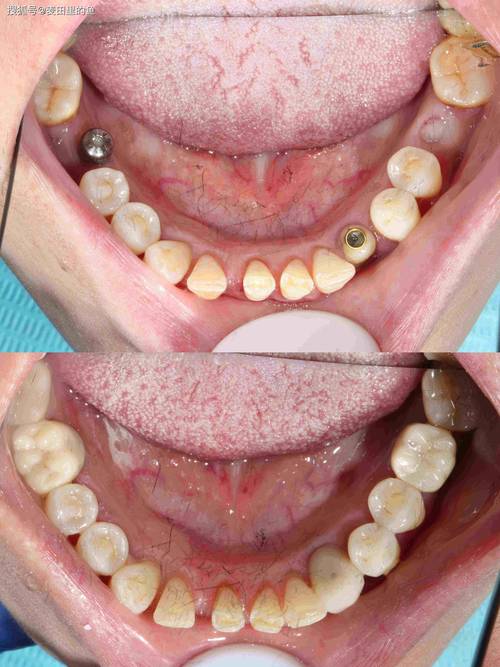 种牙后牙冠怎么戴？详细步骤有哪些？-图3