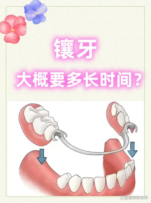 种牙后牙冠怎么戴？详细步骤有哪些？-图2