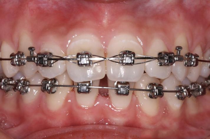 正畸矫治器的固位方式-图2