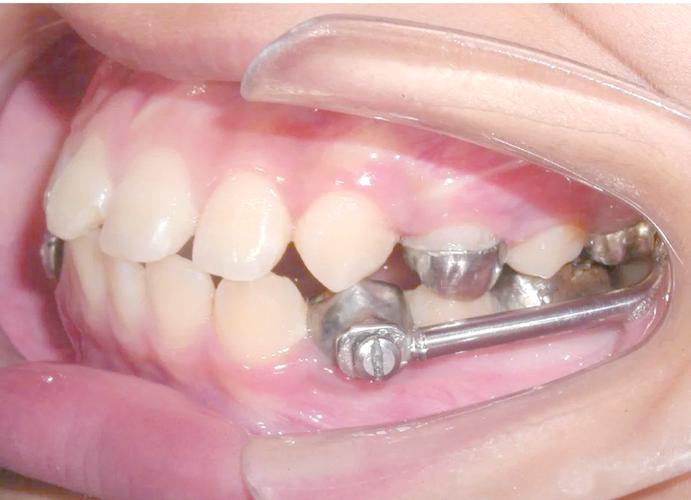 正畸矫治器的固位方式-图3