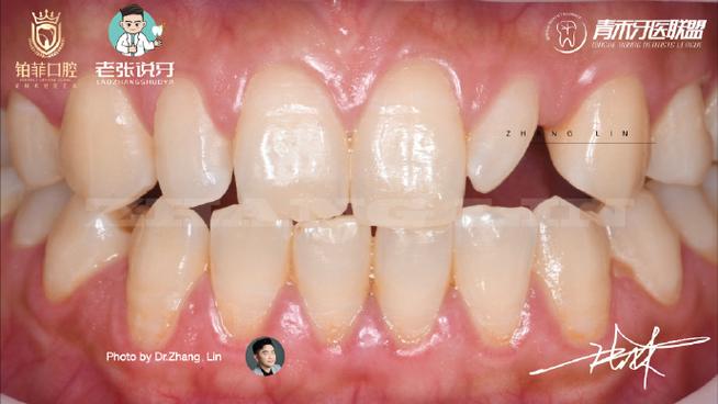 侧切牙缺失修复方法-图3