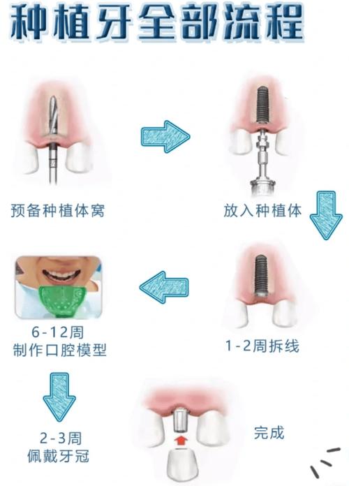 牙种植植骨的方法有哪些？不同方法如何选择与应用？-图2
