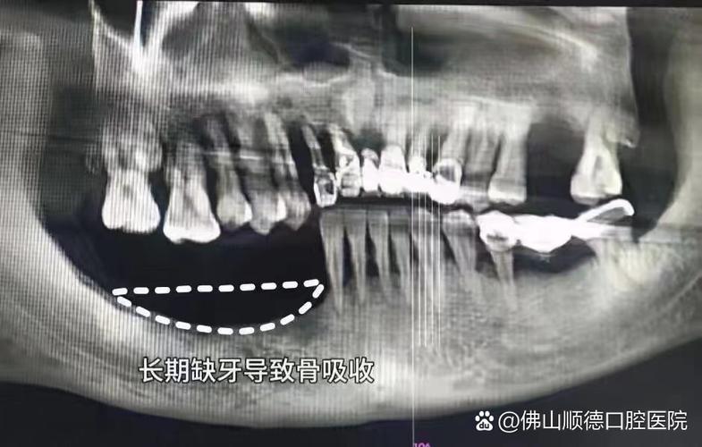 种牙后牙槽骨会长吗-图3 种牙后牙槽骨会长吗-图3