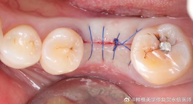 种牙愈合基台流血正常吗?需要处理吗?-图1 种牙愈合基台流血正常吗?需要处理吗?-图1