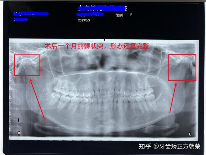 下颌骨X线投照方法的选择与操作要点有哪些？-图1