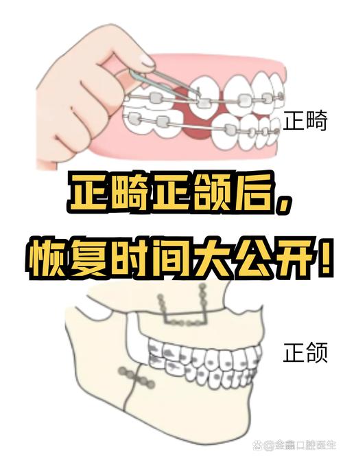 正畸后牙齿开合怎么办？原因、影响及解决方法-图2