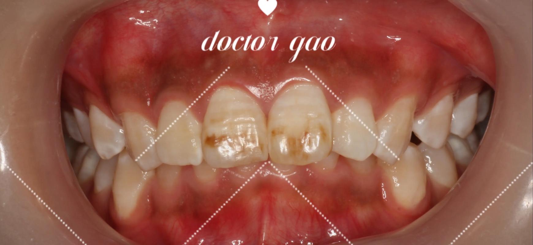 氟斑牙修复方法图解-图1