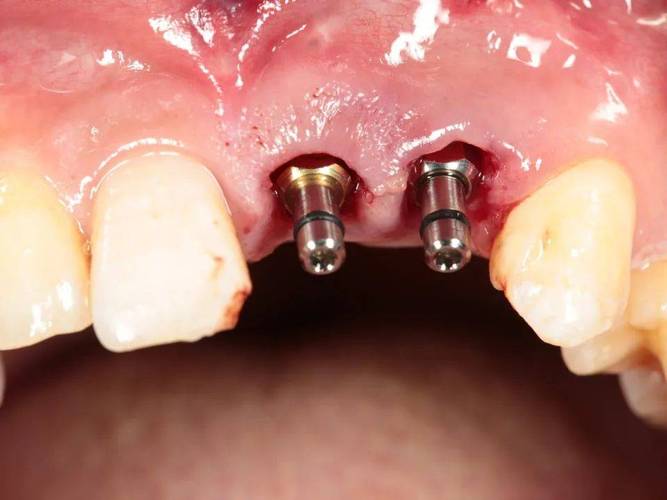 南京口腔医院种牙效果如何？价格流程是否靠谱？-图3