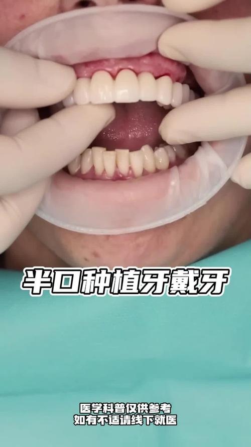 深圳即种半口种植牙，即刻种植半口牙的优势与效果如何？-图3