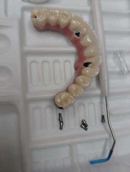 深圳即种半口种植牙，即刻种植半口牙的优势与效果如何？-图1