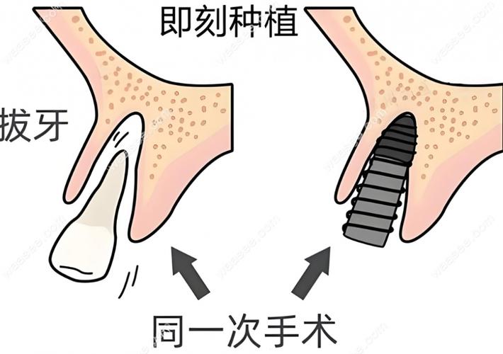全口即刻种牙需满足哪些条件？适合人群有哪些？-图1