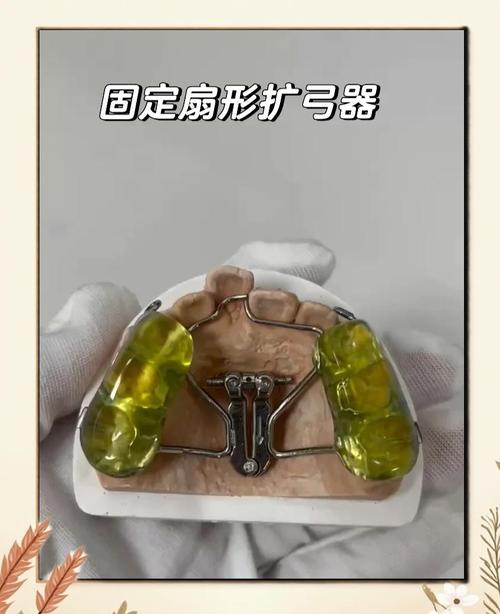 扩弓器对正畸效果影响大吗？-图3