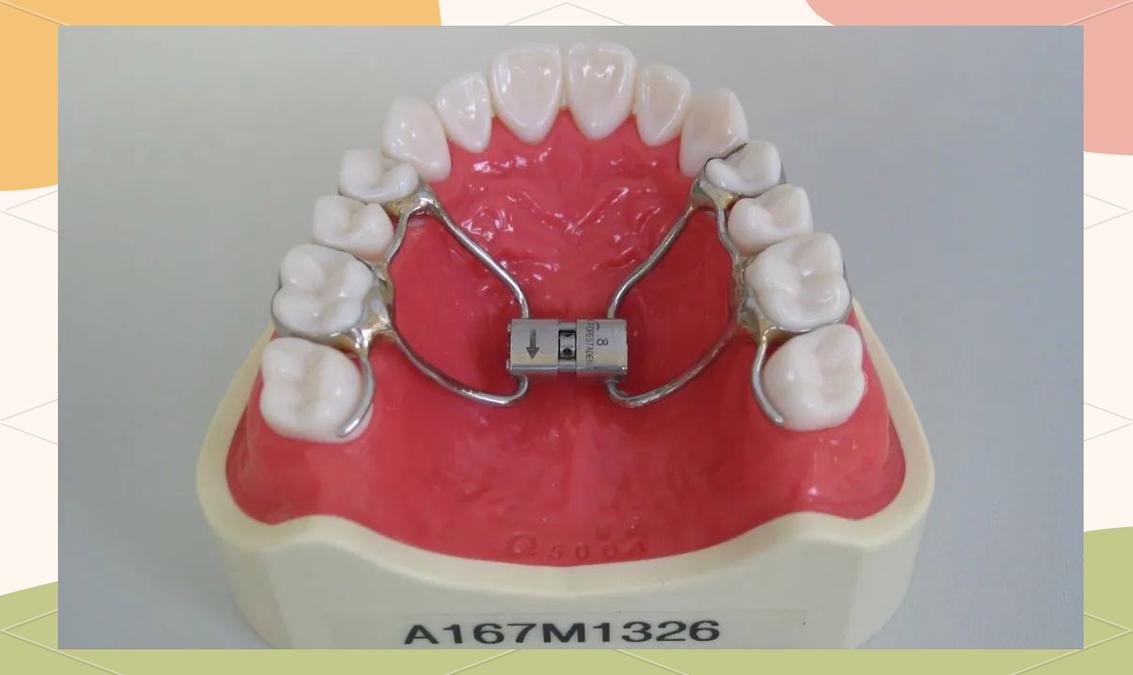 扩弓器对正畸效果影响大吗?-图1 扩弓器对正畸效果影响大吗?-图1