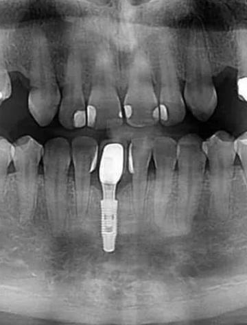 种牙能做CT检查吗？-图2