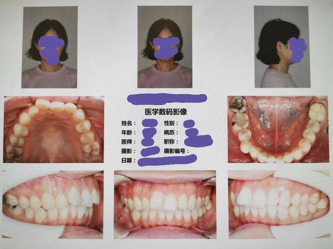 正畸正确拍照该拍哪？必拍部位与角度全解析指南-图3