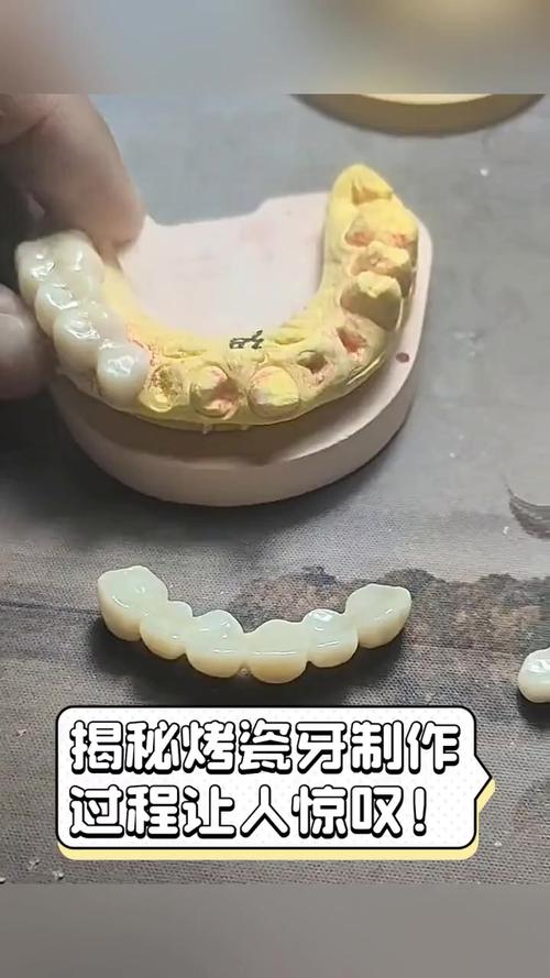 厚牙烤瓷牙制备的关键方法与操作步骤有哪些？-图2