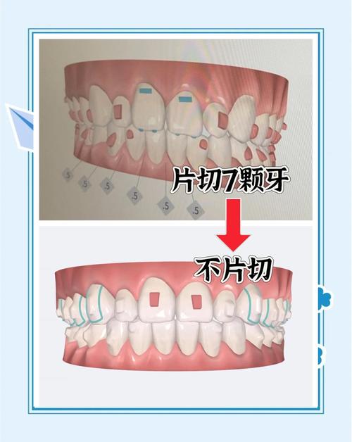 少侧切牙只正畸能矫正好吗？-图3