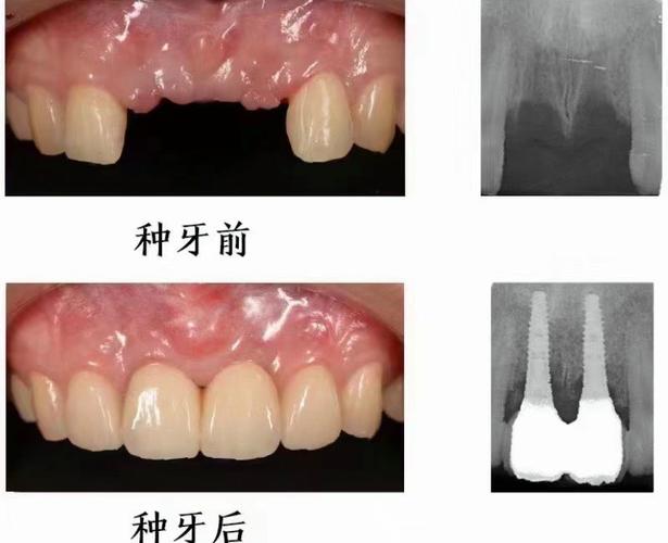 上颌后牙偏腭侧种牙-图2