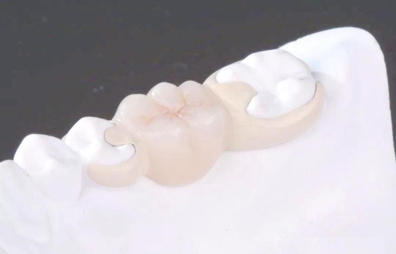 种牙与粘结桥，哪种牙齿修复方式更优？-图1