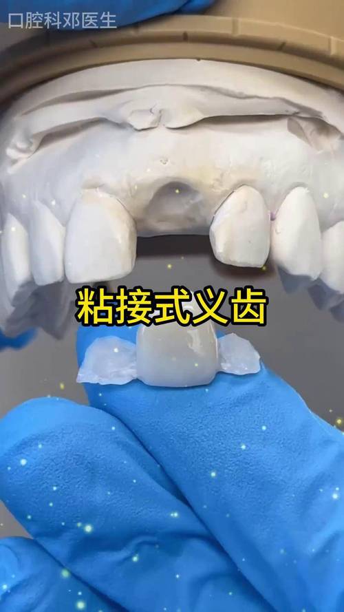 种牙与粘结桥，哪种牙齿修复方式更优？-图2