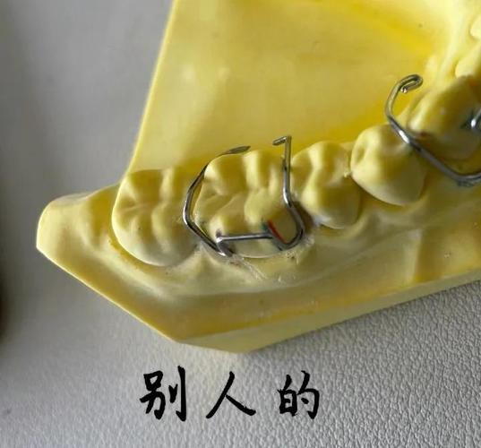 口腔正畸箭头卡弯制的关键步骤和技巧有哪些?-图3 口腔正畸箭头卡弯制的关键步骤和技巧有哪些?-图3