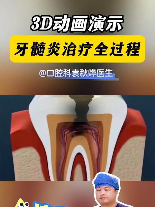 微创治疗牙髓炎方法-图3