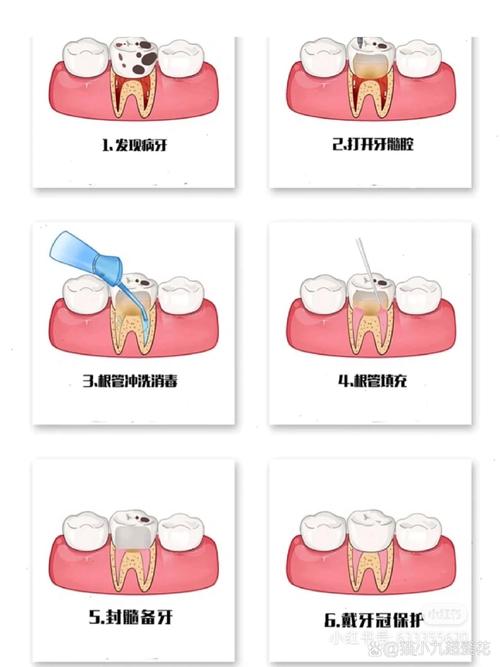 微创治疗牙髓炎方法-图2