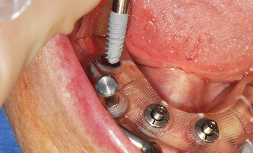 全口牙掉了要种几颗-图2 全口牙掉了要种几颗-图2