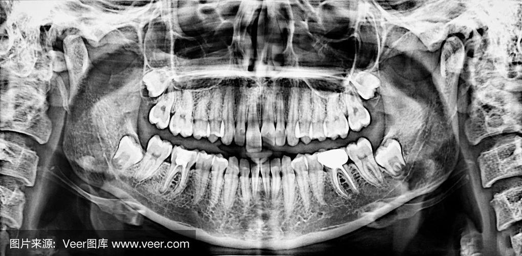 口腔科X线拍摄方法如何选择？不同类型的关键步骤与注意事项？-图3