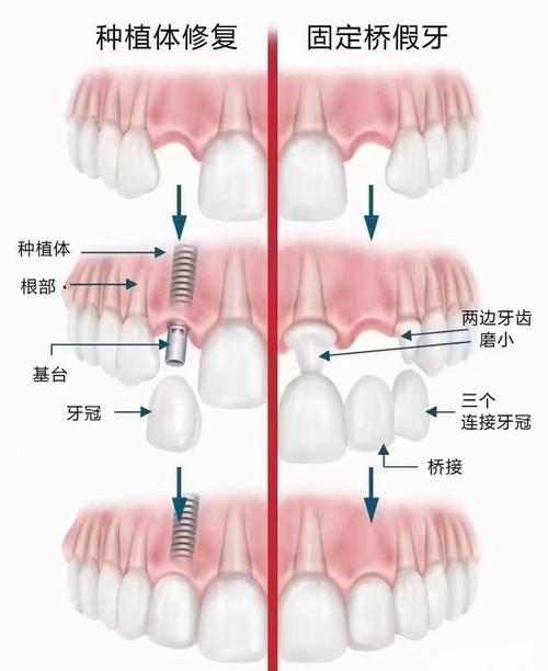 会正畸的牙医不会种植-图3