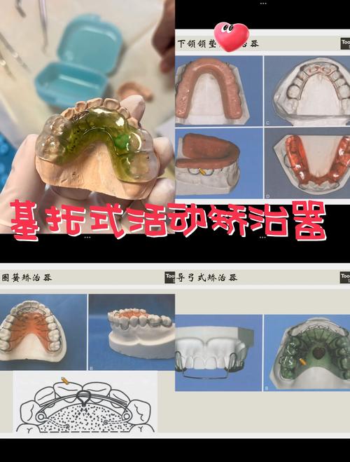 口腔科正畸器械及作用-图1 口腔科正畸器械及作用-图1