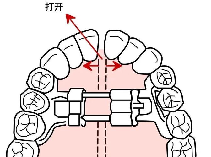 正畸扩弓有哪几种方法?如何选择适合自己的?-图1 正畸扩弓有哪几种方法?如何选择适合自己的?-图1
